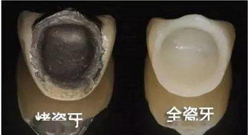 日韩牙冠,日韩牙冠美学设计与应用解析